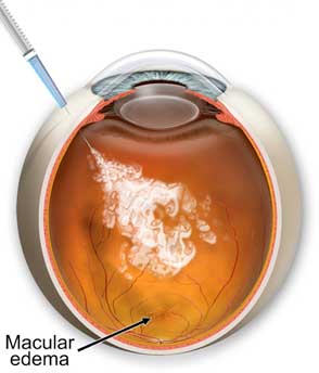 intravitreal_injection