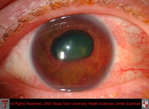 Extensive_neovascularization_of_iris_with_ectropion_uveae_due_to_neovacular_glaucoma
