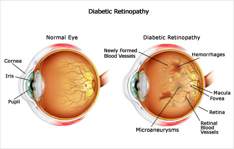 HT_eye_problems_diabetic_retinopathy_0630