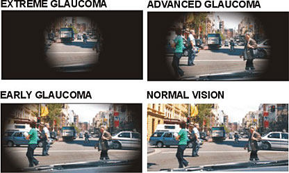 Glaucoma_adv