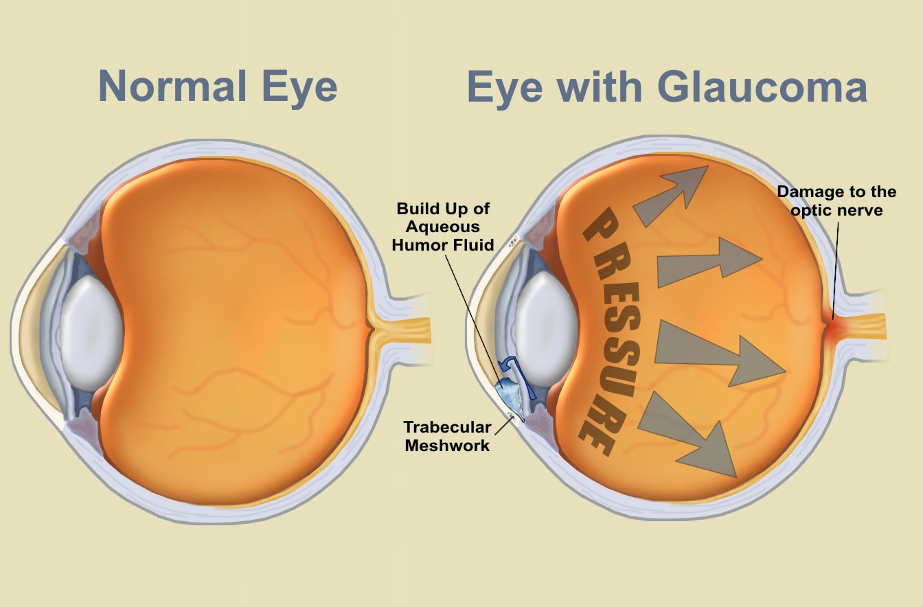 eyes_glaucoma
