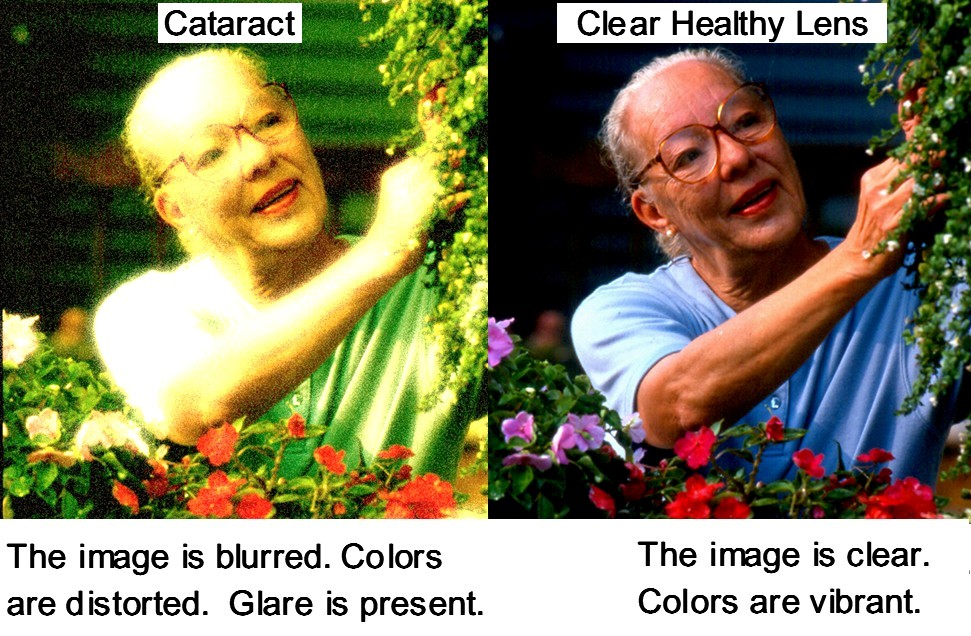 cataract_effects_1